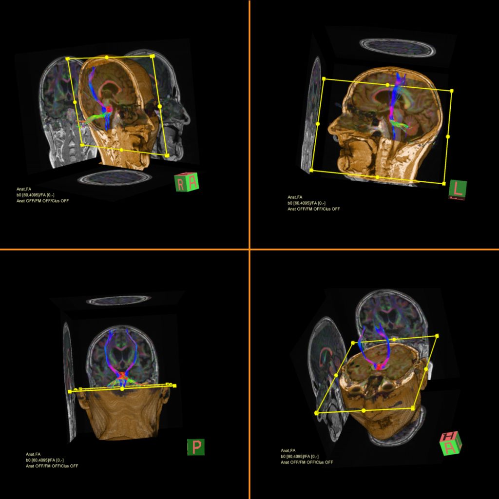 Alzheimer'da MRI Tractografi