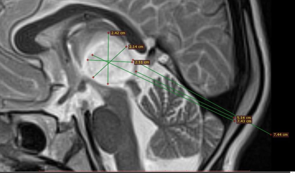 Pineal Gland Tümörü CT ve MRI Görüntüleri