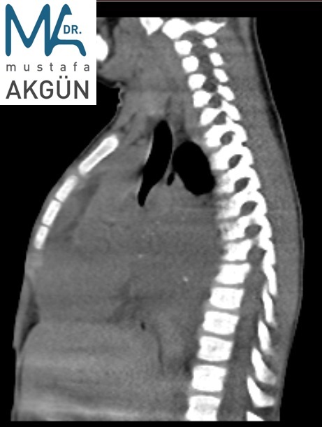 Ganglioneuroma. Sagital Torax CT   sol taraf akciğer kapasitesi azalmış, Akciğer apeksinde az miktarda havalanma var.