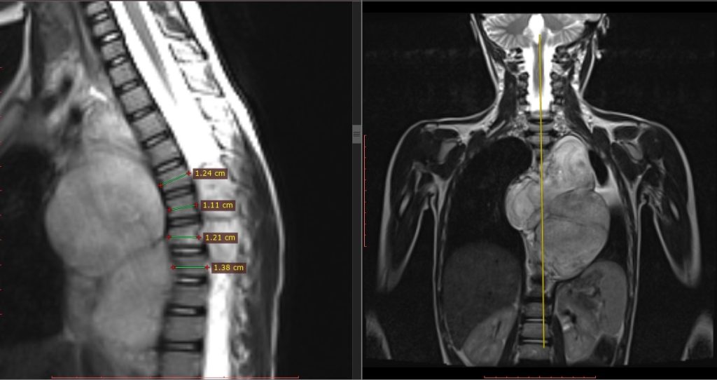 Ganglioneuroma. MRI inceleme sagital planda ve koronal planda karşılaştırmalı. Torax içinde paraspinal kitle, orta hattan sağa geçiş göstermekte, Sol toraksı tamamen doldurmuş. Spinal kanal içinde 4 segment boyunca kitle görülmekte.