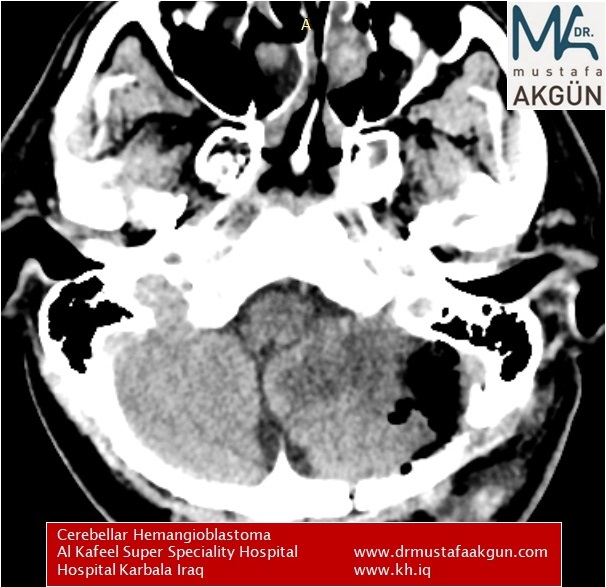 Left suboccipital craniotomy seen. At the operation area in the left cerebellum there is hypodense area due to hemosthatic material in the tumor lodge. Left cerebellar edema seen. There is no bleeding or hematoma.