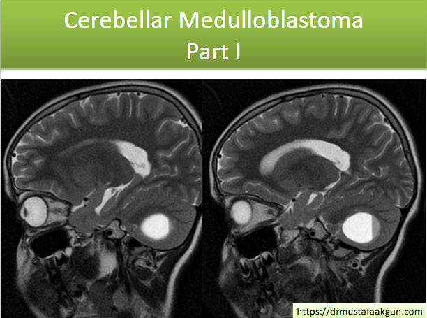 Cerebellar Medulloblastoma