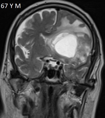 GBM-Brain-MRI-Coronal-T1-Slice