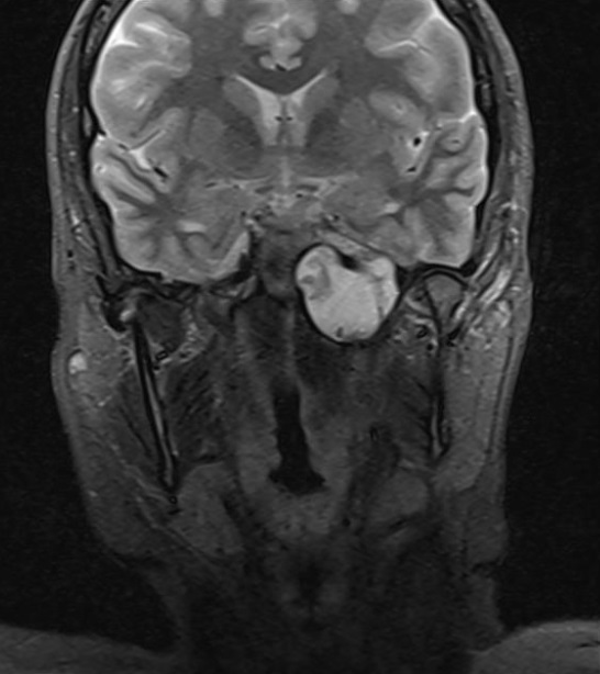 Brain MRI Coronal Slice 1