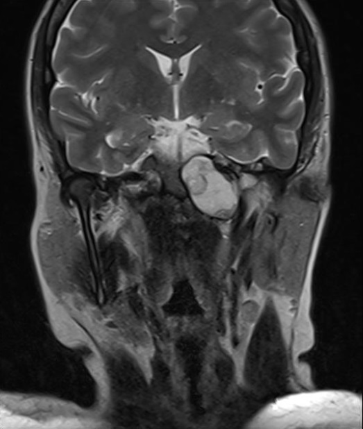 Brain MRI Coronal Slice 2