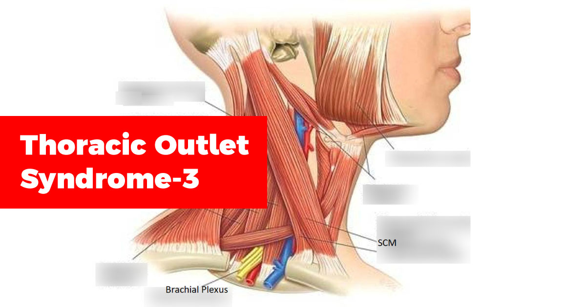 Thoracic-Outlet-Syndrome