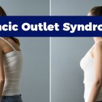 Thoracic Outlet Syndrome-5