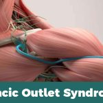 Thoracic Outlet Syndrome-7