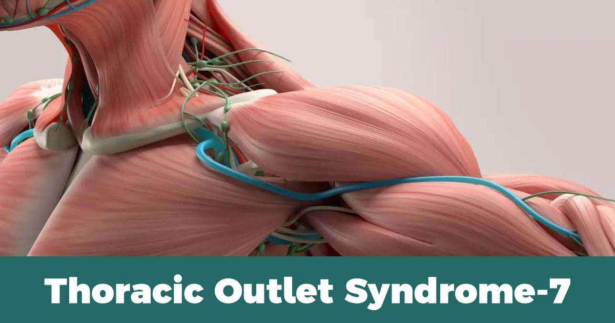 Thoracic Outlet Syndrome